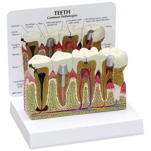 Anatomisches Modell / Zahn / Pathologie