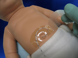 Standrohr für Intubation