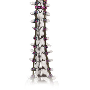 Stabilisierungssystem für Osteosynthese / Brust Lendenwirbelsäule und Kreuzbein 1
