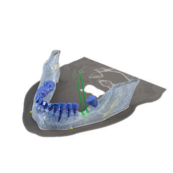 Software für Dentalimplantologie - Reconstruction 3D - Drive Dental Implants - dental- implantologische Planung / 3D-Visualisierung / Modellierung
