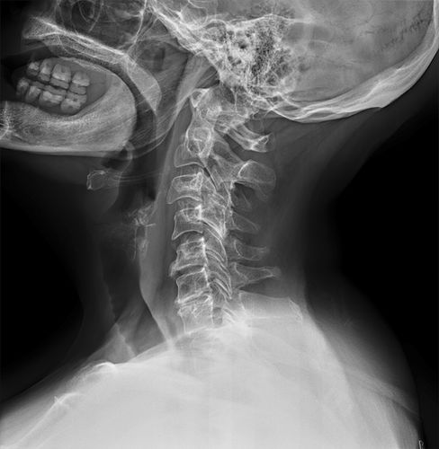 Röntgensoftware - Altumira™  - ContextVision - Angiographie / zur Bildverbesserung