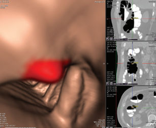 Visualisierungsalgorithmus - VeraLook® - iCAD - Erkennungshilfe / für Kliniken / Kolon