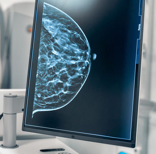 AI-Algorithmus - ProFound AI® - iCAD - Diagnose / Analyse / Umform