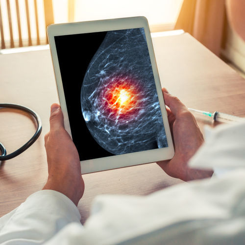 Diagnosealgorithmus - SecondLook® - iCAD - Analyse / Umform / zur Brustkrebs-Früherkennung