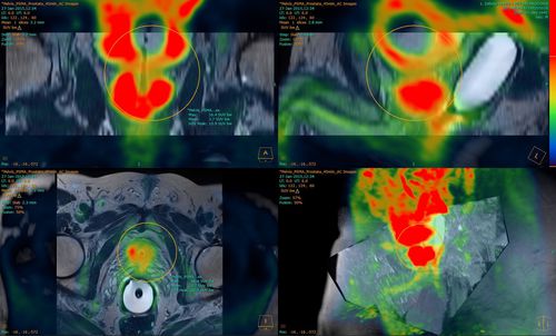 Analysesoftware - Fusion Technology™ - Hermes Medical Solutions, Inc - 3D-Visualisierung / Reporting / überwacht