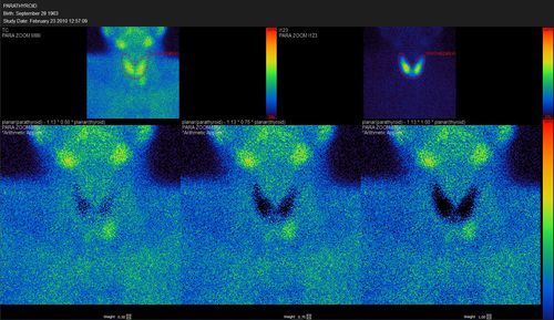 Viewer-Software - Hermes Medical Solutions, Inc - Quantifizierung / SPECT / Hormonsystem