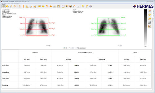Analysesoftware - Lung Lobe Quantification™ - Hermes Medical Solutions, Inc - Diagnose / Planung / Bewertung