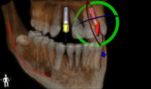 3D-Visualisierung-Software - Blue Sky Plan - BlueSkyBio - Planung / Umform / für Chirurgie