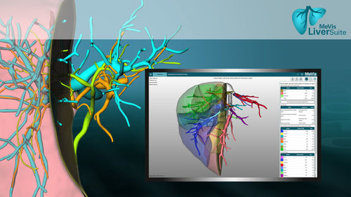 Bildanalyse-Software - LiverSuite - MeVis Medical Solutions AG - Visualisierung / Behandlungsplanung / Bildimport