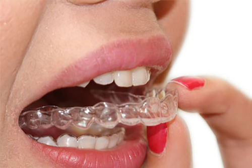 Aligner - Smilers  - BIOTECH DENTAL