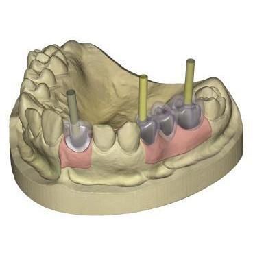 Software-Modul / für Dentalimplantologie - 4207 - Champions Implants GmbH - Projektentwicklung / CAD