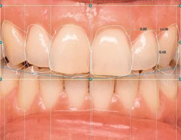 Software-Modul / Dental - 4218 - Champions Implants GmbH - Projektentwicklung / CAD / für digitales Lächelndesign