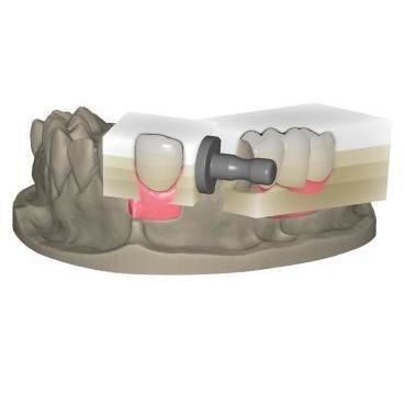 Software-Modul / zur Dentalrestaurierung - In-Cad Nesting - Champions Implants GmbH - Projektentwicklung / Fertigung / Zahn