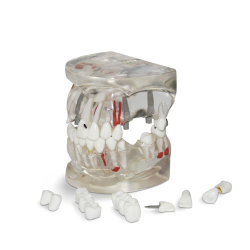 Anatomisches Modell / Nerv - T04 - GF DENTAL - Unterkiefer / Zahn / für Implantologie