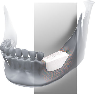 Allograft-Knochenersatzmaterial - Global D - für Zahnchirurgie / biegesteif