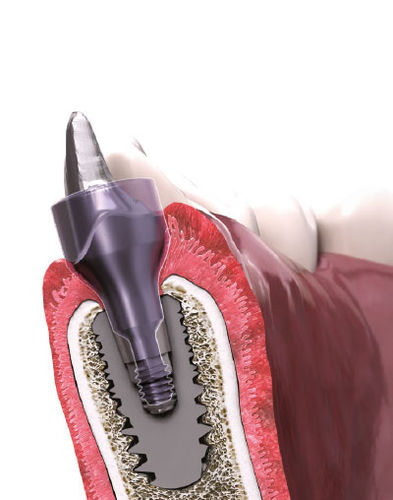 Gingivalformer - IN-KONE® - Global D
