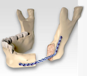 Osteotomieplatte für Unterkiefer - CARCITEK  - Global D - mit Verriegelung / Metall