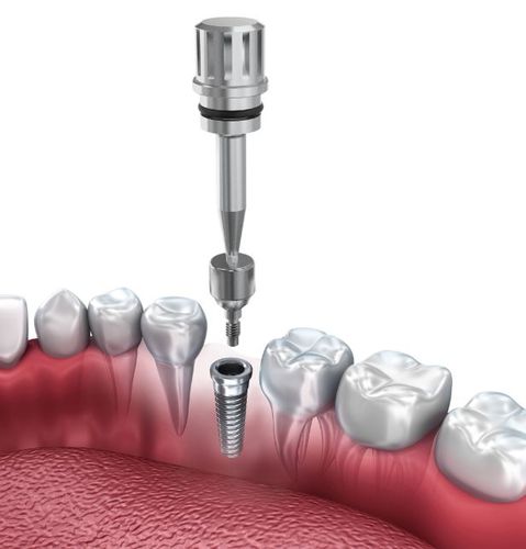 Zylindrischer Gingivaformer - MagDent - Titan / Schrauben