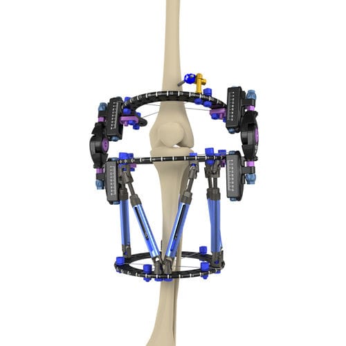 Fixateur externe / Knie - Response Ortho - hybrid / für Erwachsene