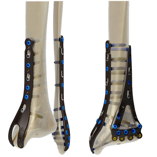 Kompressionsplatte für Fibula -  STEP® - Response Ortho - für Tibia / distal / ohne Verriegelung