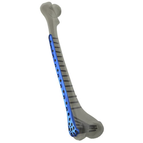 Kompressionsplatte für Oberschenkelknochen - Response Ortho - distal / mit Verriegelung / Metall