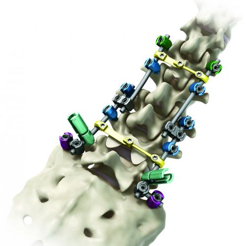 Stabilisierungssystem für Osteosynthese / Brust Lendenwirbelsäule und Kreuzbein - Streamline® TL - RTI Surgical - dorsaler Zugang / für Erwachsene