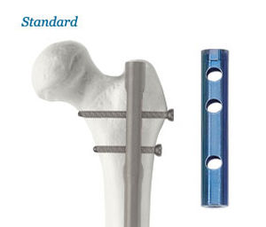 Marknagel für Oberschenkelknochen - AOS - Advanced Orthopaedic Solutions