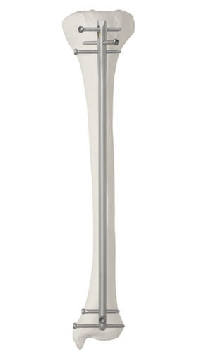 Marknagel / für Schienbein - Da Vinci™ - AOS - Advanced Orthopaedic Solutions - mit proximaler Fixierung / mit distaler Fixierung