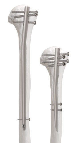 Marknagel / Humerus - Newton™ - AOS - Advanced Orthopaedic Solutions - mit proximaler Fixierung