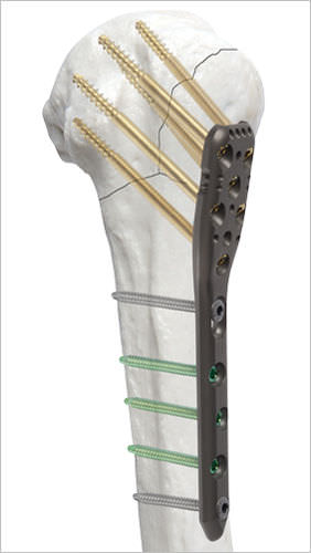 Kompressionsplatte für Humerus - AOS - Advanced Orthopaedic Solutions - proximal / mit Verriegelung / Metall