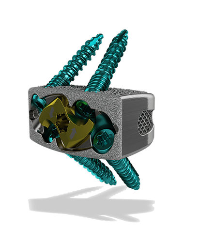 LWS-Zwischenwirbelimplantat - Harrier® SA - ChoiceSpine - ventraler Zugang / Titan / 3D-Druck