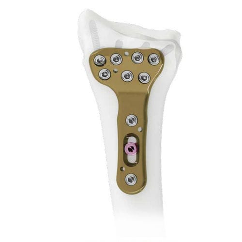 Kompressionsplatte für Radius - Wristar - Intrauma - distal / mit Verriegelung / Metall