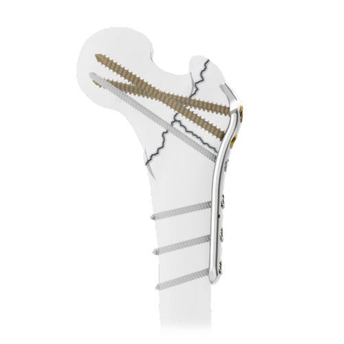 Kompressionsplatte für Oberschenkelknochen - PFF  - Intrauma - für Trochanter / proximal / medial