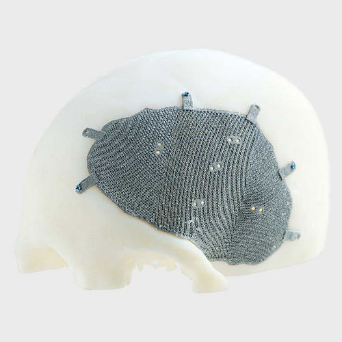 Patientenspezifisches Schädelimplantat - Medyssey Spine