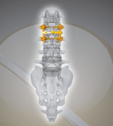 Stabilisierungssystem für Osteosynthese / LWS - NEX D2 - Next Orthosurgical - dorsaler Zugang / für Erwachsene