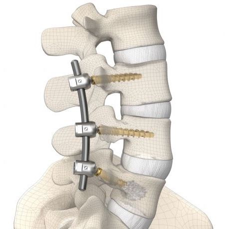 Thorako-lumbales Stabilisierungssystem für Osteosynthese - DIPLOMAT®  - Signus Medical - dorsaler Zugang / für Erwachsene