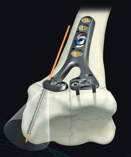 Kompressionsplatte für Radius - GEMINUS ® - Skeletal Dynamics - distal / Metall