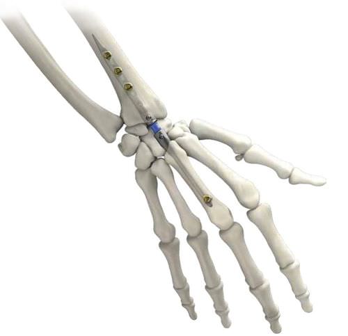 Marknagel für Handgelenk - IMPLATE ® - Skeletal Dynamics