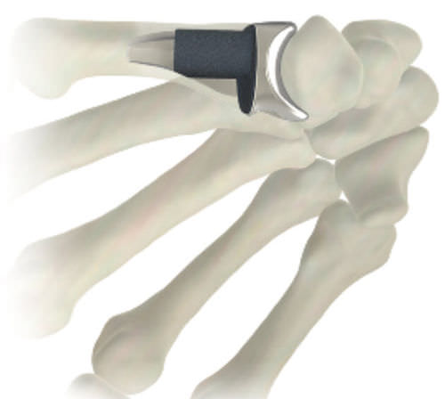 Implantat für Metacarpophalangealgelenk - STABLYX ® - Skeletal Dynamics