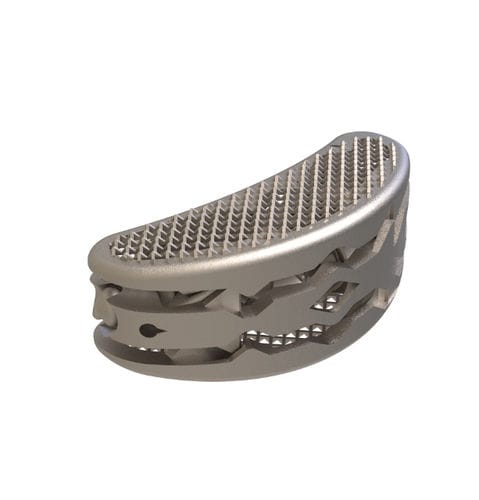 LWS-Zwischenwirbelimplantat - Ustica TLIF  - Tsunami Medical - transforaminaler Zugang / Titan
