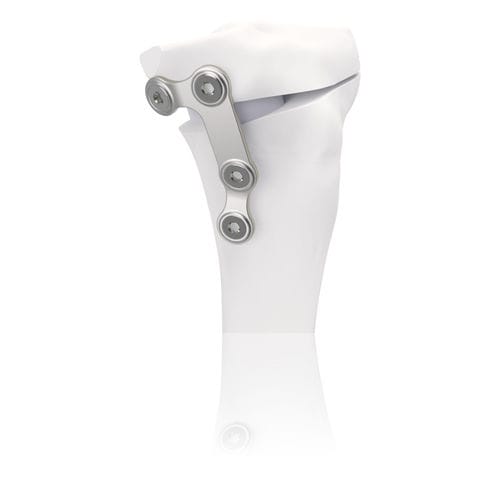 Osteotomieplatte für Tibia - TBFIX™ - Groupe Lépine - Edelstahl