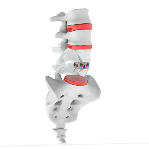 LWS-Zwischenwirbelimplantat - ANTENOR STAND ALONE ALIF CAGE - Osimplant - ventraler Zugang / Titan