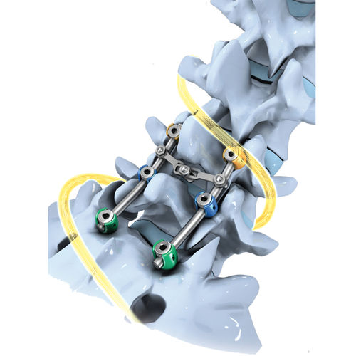 Stabilisierungssystem für Osteosynthese / Lumbal-Sakral - SLICK'S® - Biotechni - dorsaler Zugang / für Erwachsene