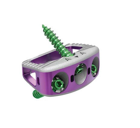 LWS-Zwischenwirbelimplantat - ALIF - NuVasive - ventraler Zugang
