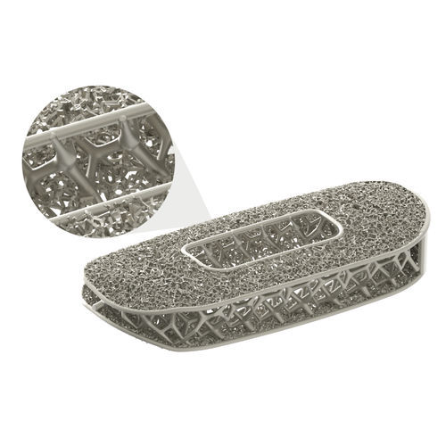 HWS-Zwischenwirbelimplantat - Modulus® - NuVasive - ventraler Zugang / Titan