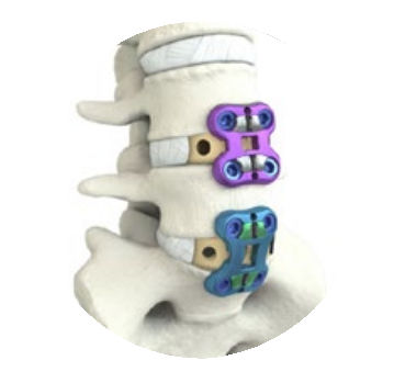 LWS-Arthrodeseplatte - ALIF - NuVasive - Metall / 1 Ebene
