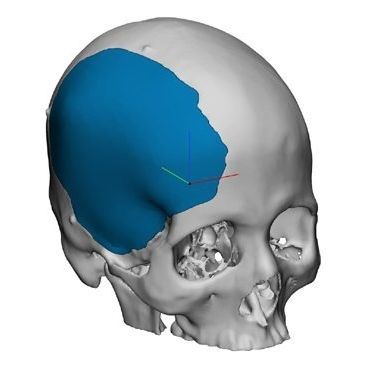 Patientenspezifisches Schädelimplantat - OP89020 - Matrix Surgical USA