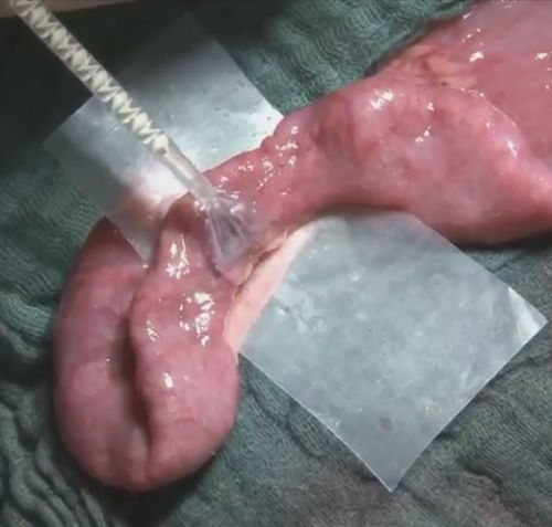 Chirurgischer Kleber / für Gefäßchirurgie - VIVO - Adhesys Medical