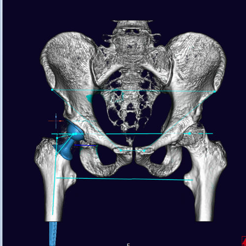 Orthopädie-Software - mediCAD Hectec GmbH