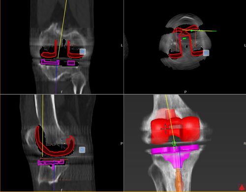 Orthopädie-Software - mediCAD Hectec GmbH